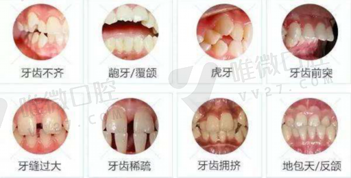 选择矫治器的参考因素（影响矫治过程中牙周组织改建的因素）(图1)